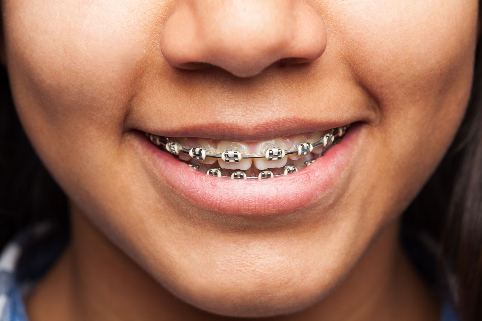 Todo Lo Que Debes Saber De Los Brackets Mujer Ejecutiva